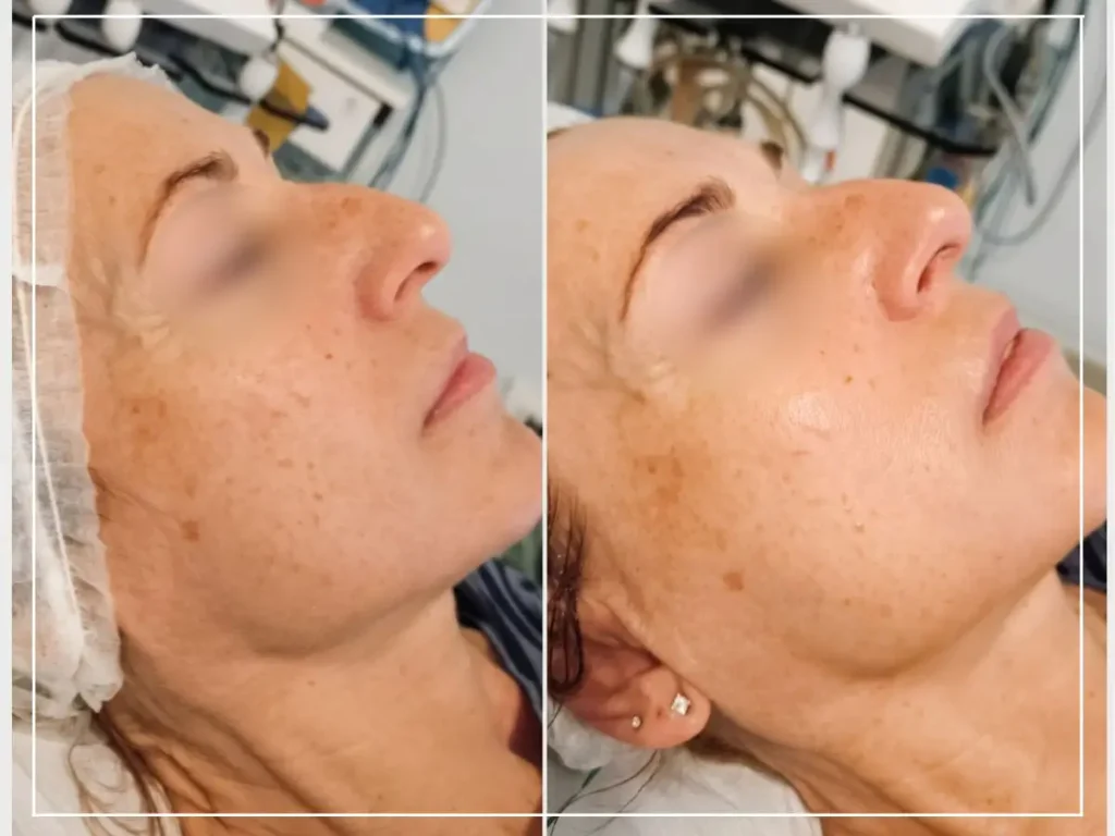 Risultato trattamento viso prima e dopo